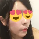 スレッドノーズ / ヒアルロン酸注入（鼻） / ヒアルロン酸注入（あご） / ヒアルロン酸注入（額） キップン整形外科 DAY 3 サムネイル用