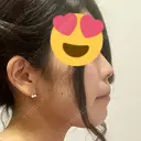 スレッドノーズ / ヒアルロン酸注入（鼻） / ヒアルロン酸注入（あご） / ヒアルロン酸注入（額） キップン整形外科 DAY 101 サムネイル用