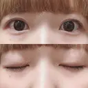 二重切開 松下皮フ形成外科 AFTER サムネイル用