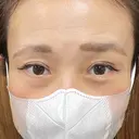 二重切開 / 眼瞼下垂（切開） 湘南美容クリニック Regno 銀座院 DAY 47 サムネイル用