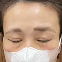二重切開 / 眼瞼下垂（切開） 湘南美容クリニック Regno 銀座院 DAY 47 サムネイル用