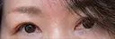 眉下切開 松下皮フ形成外科 AFTER サムネイル用