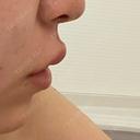 ボトックス（人中） AILE Clinic DAY 1 サムネイル用