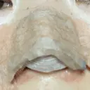 軟骨移植 フェアクリニック川口 DAY 3 サムネイル用