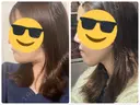 骨切り（あご） ヤスミクリニック DAY 50 サムネイル用