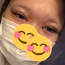 二重埋没 / 目頭切開 聖心美容クリニック 福岡院 DAY 1 サムネイル用