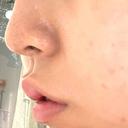 ボトックス（人中） AILE Clinic DAY 4 サムネイル用