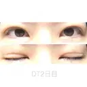 二重埋没 湘南美容クリニック 福島院 DAY 2 サムネイル用