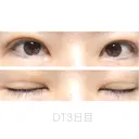 二重埋没 湘南美容クリニック 福島院 DAY 3 サムネイル用
