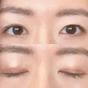 二重切開 城本クリニック 長崎院 AFTER サムネイル用