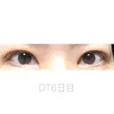二重埋没 湘南美容クリニック 福島院 DAY 6 サムネイル用