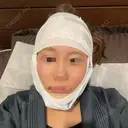 骨切り（あご） 銀座マイアミ美容外科 AFTER サムネイル用