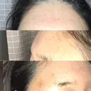 額を丸く / こめかみ形成 / その他（肌） / 再生医療 / PRP皮膚再生療法 クリニックビューティー恵比寿 DAY 2 サムネイル用