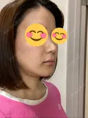 骨切り（あご） / 骨削り（エラ） / その他（輪郭） / セットバック アーククリニック DAY 8 サムネイル用