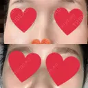 額を丸く / こめかみ形成 / その他（肌） / 再生医療 / PRP皮膚再生療法 クリニックビューティー恵比寿 DAY 5 サムネイル用