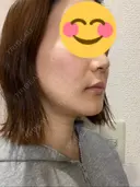 骨切り（あご） / 骨削り（エラ） / その他（輪郭） / セットバック アーククリニック DAY 12 サムネイル用