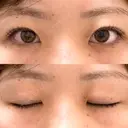 二重埋没 R.O.clinic DAY 558 サムネイル用