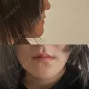 骨切り（あご） / 脂肪吸引（顔） / その他（輪郭） 銀座マイアミ美容外科 DAY 84 サムネイル用