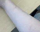 傷跡修正 酒井形成外科 DAY 414 サムネイル用