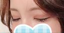 二重切開 / 上まぶたの脂肪取り id（アイディ）美容外科 DAY 45 サムネイル用