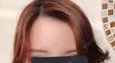 額を丸く / 脂肪注入（額） id（アイディ）美容外科 DAY 45 サムネイル用