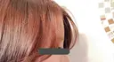 額を丸く / 脂肪注入（額） id（アイディ）美容外科 DAY 45 サムネイル用
