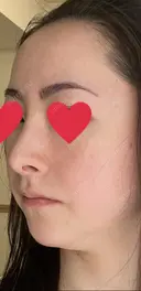 隆鼻術 / 鼻尖形成（切開） / 軟骨移植 湘南美容クリニック 辻堂アカデミア DAY 21 サムネイル用