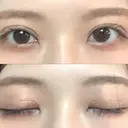 二重切開 / その他（目元） LIKI CLINIC KOBE DAY 81 サムネイル用