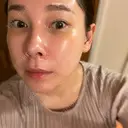 ヴェルヴェットスキン MSC LUNA CLINIC 渋谷院 AFTER サムネイル用