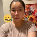 ヴェルヴェットスキン MSC LUNA CLINIC 渋谷院 DAY 2 サムネイル用