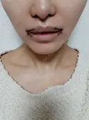 小鼻縮小（切開） / 人中短縮 / 口角挙上 / その他（口元） オザキクリニック LUXE新宿 DAY 0 サムネイル用