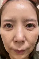 糸リフト / クマ治療 / 下まぶたたるみ取り / 下まぶたの脂肪取り / 眉下切開 / 脂肪注入（額） 銀座みゆき通り美容外科 東京本院 DAY 60 サムネイル用