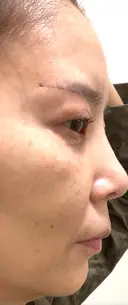糸リフト / クマ治療 / 下まぶたたるみ取り / 下まぶたの脂肪取り / 眉下切開 / 脂肪注入（額） 銀座みゆき通り美容外科 東京本院 DAY 60 サムネイル用