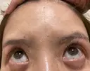 糸リフト / クマ治療 / 下まぶたたるみ取り / 下まぶたの脂肪取り / 眉下切開 / 脂肪注入（額） 銀座みゆき通り美容外科 東京本院 DAY 60 サムネイル用