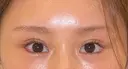 目尻靭帯移動 R.O.clinic DAY 49 サムネイル用