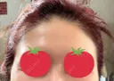 額を丸く / こめかみ形成 / その他（肌） / 再生医療 / PRP皮膚再生療法 クリニックビューティー恵比寿 DAY 16 サムネイル用