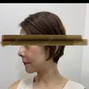 鼻尖縮小 リッツ美容外科 大阪院 DAY 201 サムネイル用