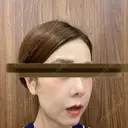 鼻尖縮小 リッツ美容外科 大阪院 DAY 211 サムネイル用