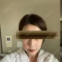 鼻尖縮小 リッツ美容外科 大阪院 DAY 406 サムネイル用