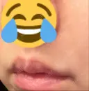 肌ヒアルロン酸注入（たるみ・シワ改善） 湘南美容クリニック 宇都宮院 DAY 9 サムネイル用