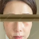 鼻尖縮小 リッツ美容外科 大阪院 AFTER サムネイル用