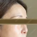 鼻尖縮小 リッツ美容外科 大阪院 DAY 408 サムネイル用