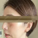 鼻尖縮小 リッツ美容外科 大阪院 DAY 408 サムネイル用