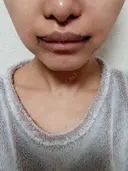 小鼻縮小（切開） / 人中短縮 / 口角挙上 / その他（口元） オザキクリニック LUXE新宿 DAY 3 サムネイル用