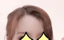 額を丸く / 脂肪注入（額） id（アイディ）美容外科 DAY 55 サムネイル用