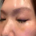 下まぶたの脂肪取り 芦屋美容クリニック 芦屋院 DAY 4 サムネイル用