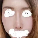 隆鼻術 / 鼻尖形成（切開） / 鼻中隔延長（切開） / 軟骨移植 / 骨切幅寄せ / 真皮移植 表参道スキンクリニック 大阪院 AFTER サムネイル用