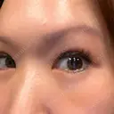 下まぶたの脂肪取り 芦屋美容クリニック 芦屋院 DAY 5 サムネイル用