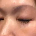 下まぶたの脂肪取り 芦屋美容クリニック 芦屋院 DAY 5 サムネイル用