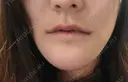骨切り（あご） / セットバック / 輪郭修正 リラ・クラニオフェイシャル・クリニック 大阪院 AFTER サムネイル用